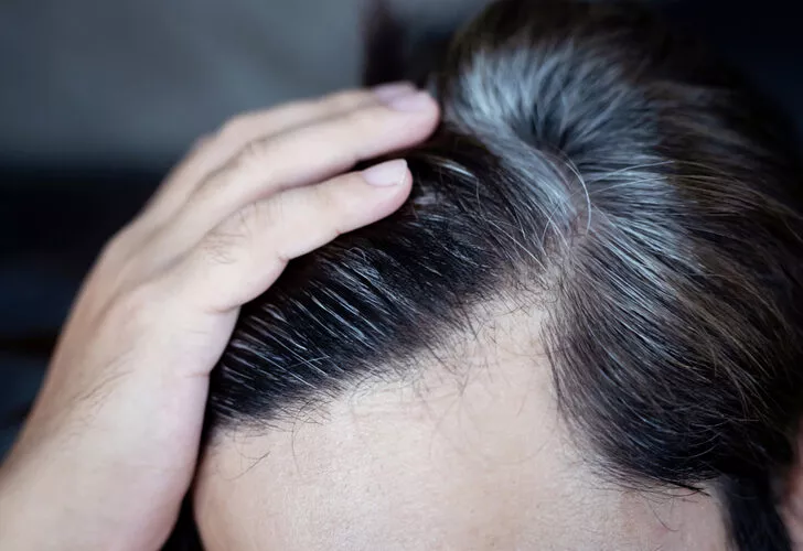 Saçları ən çox nə ağardır? Stress yoxsa qidalanma?